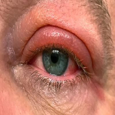 Putrefaction Blood Stained Fluid At Nostrils Swollen Eye Lid