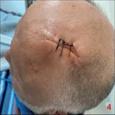 Revealing Emphasis Of Suture Removal For Study