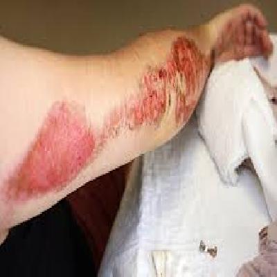 Road Accident Small Multiple Abrasions And Confusion In Fore