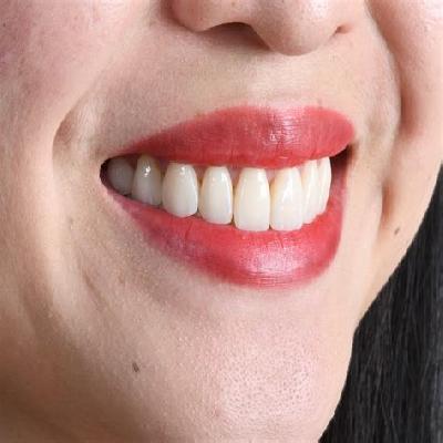 veneers