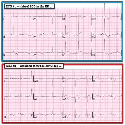 Ecg 